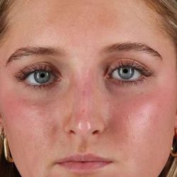 Liquid Rhinoplasty Before & After Patient #6388