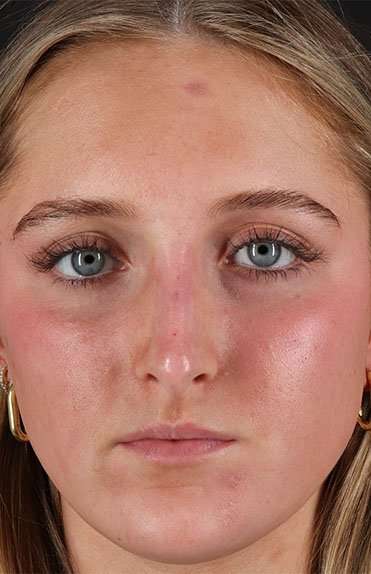 Liquid Rhinoplasty Before & After Patient #6388