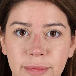 Liquid Rhinoplasty Before & After Patient #6399