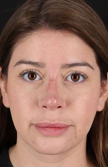 Liquid Rhinoplasty Before & After Patient #6399