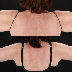 Brachioplasty (Arm Lift) Before & After Patient #1172