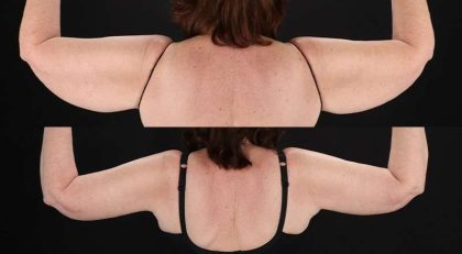 Brachioplasty (Arm Lift) Before & After Patient #1172