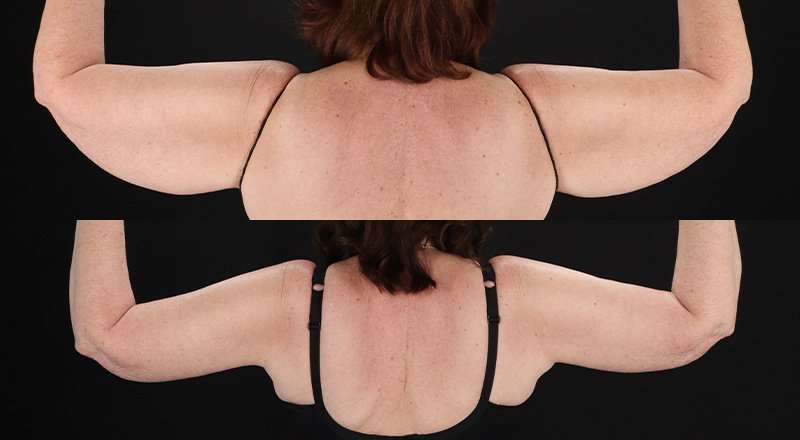 Brachioplasty (Arm Lift) Before & After Patient #1172