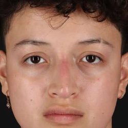 Liquid Rhinoplasty Before & After Patient #6410