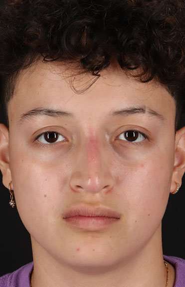 Liquid Rhinoplasty Before & After Patient #6410