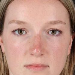 Liquid Rhinoplasty Before & After Patient #6425