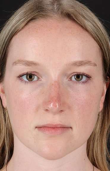 Liquid Rhinoplasty Before & After Patient #6425