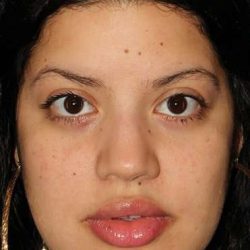 Buccal Fat Pad Before & After Patient #6436