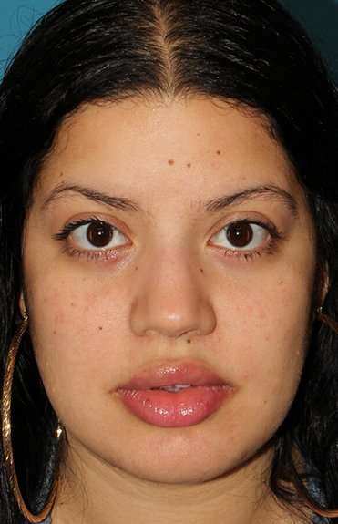 Buccal Fat Pad Before & After Patient #6436