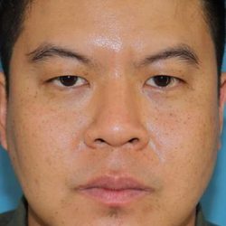 Buccal Fat Pad Before & After Patient #6441