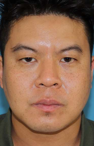 Buccal Fat Pad Before & After Patient #6441