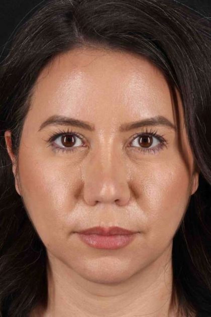 Buccal Fat Pad Before & After Patient #6463