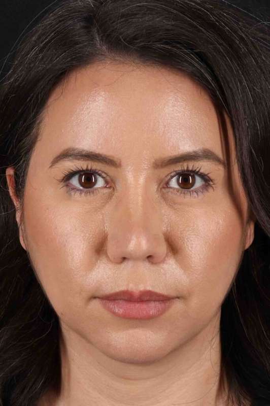 Buccal Fat Pad Before & After Patient #6463
