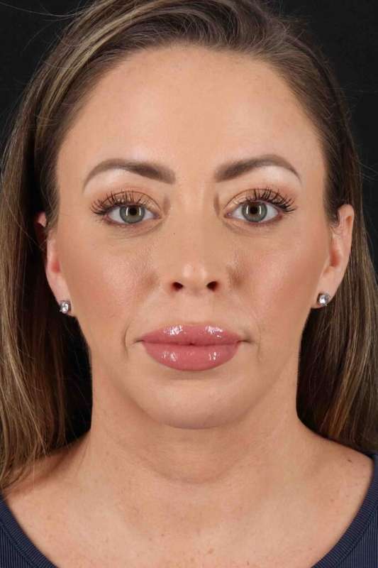 Buccal Fat Pad Before & After Patient #6474