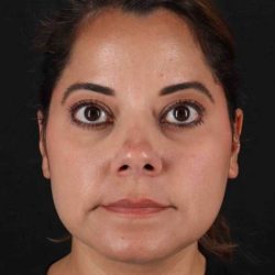 Buccal Fat Pad Before & After Patient #6485