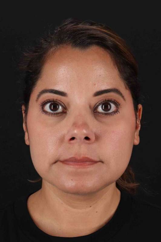 Buccal Fat Pad Before & After Patient #6485