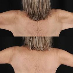 Brachioplasty (Arm Lift) Before & After Patient #1175
