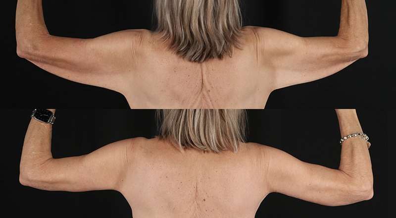 Brachioplasty (Arm Lift) Before & After Patient #1175