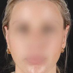 Otoplasty Before & After Patient #6506