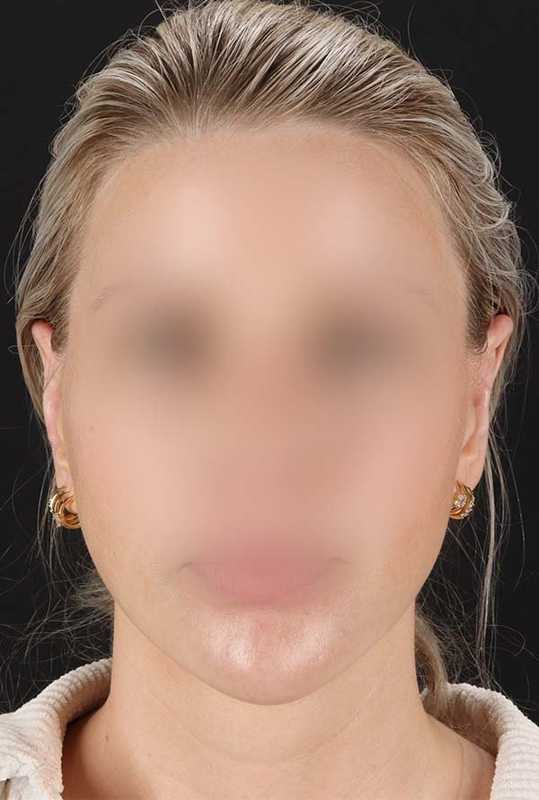 Otoplasty Before & After Patient #6506