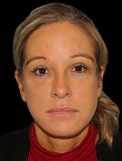 Neck Lift Before & After Patient #6517
