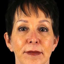 Neck Lift Before & After Patient #6528