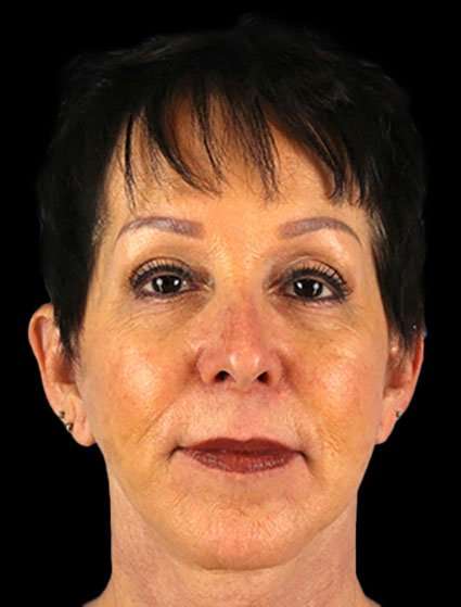 Neck Lift Before & After Patient #6528