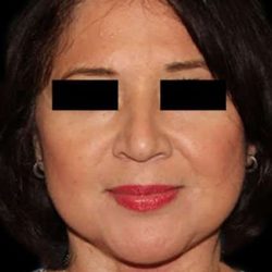 Neck Lift Before & After Patient #6539