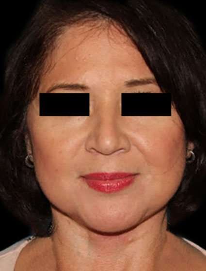 Neck Lift Before & After Patient #6539