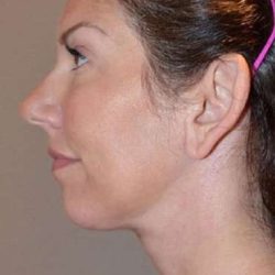 Neck Lift Before & After Patient #6549