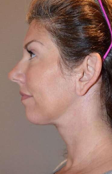 Neck Lift Before & After Patient #6549