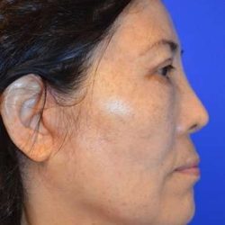 Neck Lift Before & After Patient #6552