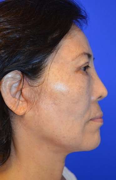 Neck Lift Before & After Patient #6552