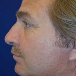 Neck Lift Before & After Patient #6555