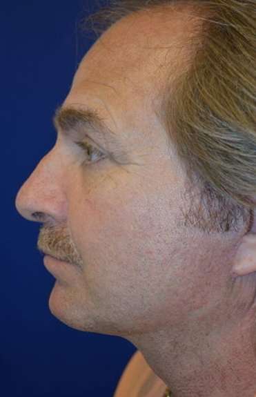 Neck Lift Before & After Patient #6555