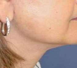 Neck Lift Before & After Patient #6558