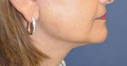 Neck Lift Before & After Patient #6558