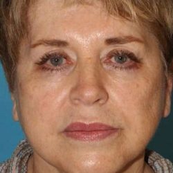 Neck Lift Before & After Patient #6565