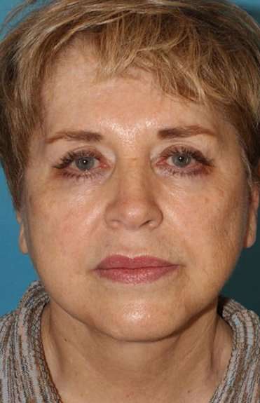 Neck Lift Before & After Patient #6565