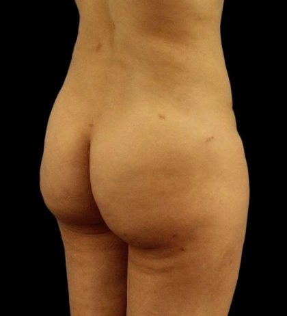 Cosmetic Body Lift Before & After Patient #1186