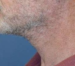 Neck Lift Before & After Patient #6568