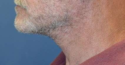 Neck Lift Before & After Patient #6568