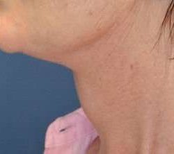 Neck Lift Before & After Patient #6571
