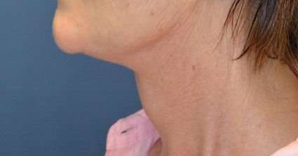 Neck Lift Before & After Patient #6571