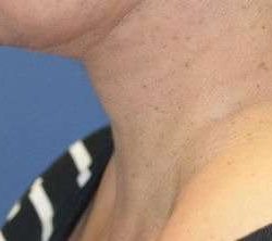 Neck Lift Before & After Patient #6574
