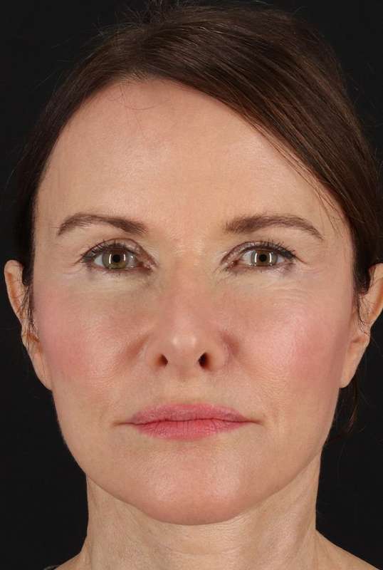 Neck Lift Before & After Patient #6631