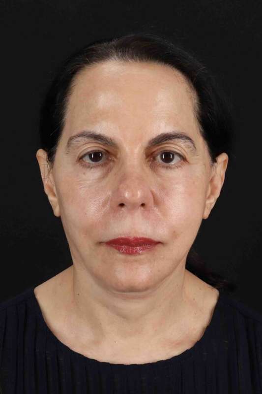 Neck Lift Before & After Patient #6642