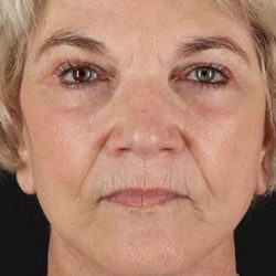 Neck Lift Before & After Patient #6654