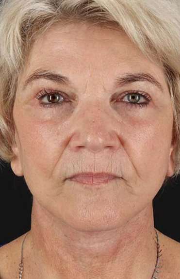 Neck Lift Before & After Patient #6654