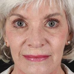 Neck Lift Before & After Patient #6665